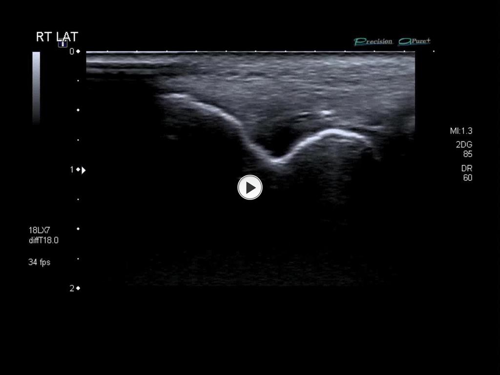 Fig. 3: Right common extensor tendon PRP