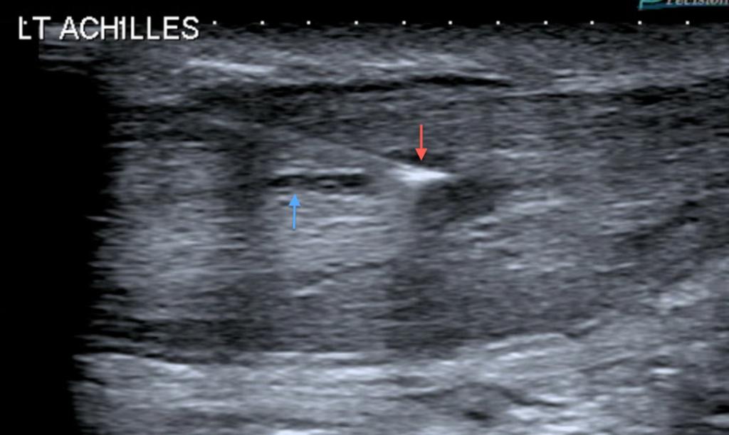Fig. 4: Left achilles tendon, immediately prior to injection.
