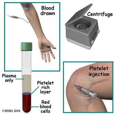 Introduction Platelet-rich plasma (PRP) (also known as blood injection therapy) is a medical treatment being used for a wide range of musculoskeletal problems.