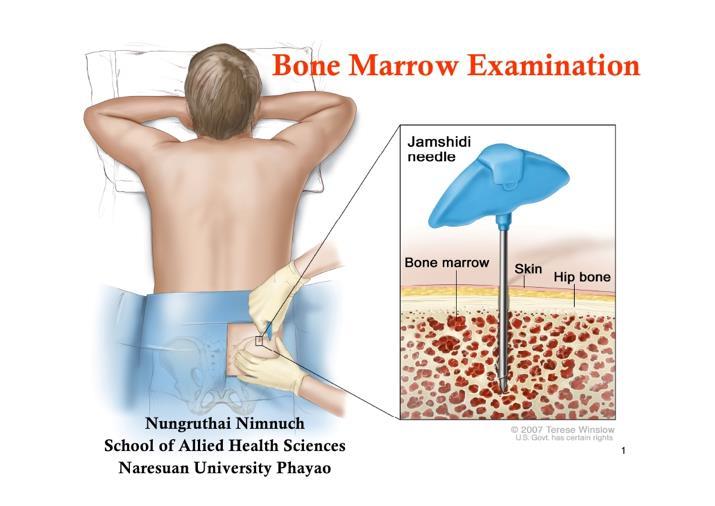Bone Marrow Procedure Bone marrow extracted from the patient s hip