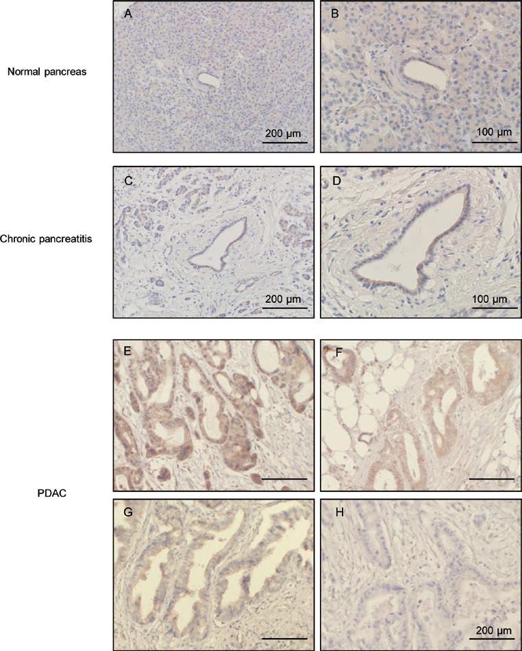 632 fujit et l: EGFR mrna expression in PDAC Figure 1. Immunohistochemicl nlysis of EGFR in norml pncres, chronic pncretitis nd PDAC tissues.