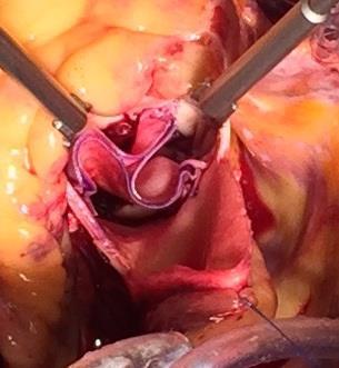 Osaki Procedure Is an aortic valve reconstruction (AV neo-cuspidisation) using aortic leaflet made