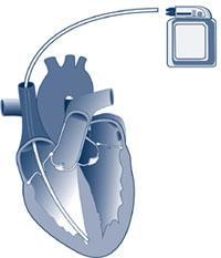 Guidelines for Patients with Implantable Devices o Implantable Cardioverter Defibrillator (ICD) Your ICD is approximately the size of a pager and includes the following parts: The ICD: A battery