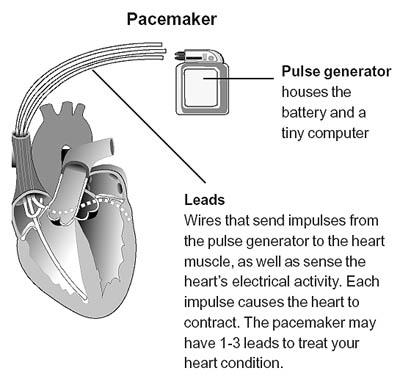 Biventricular pacemaker: (pictured here) Uses three leads, placed in the: Right atrium, Right ventricle, Left ventricle (via the coronary sinus vein).