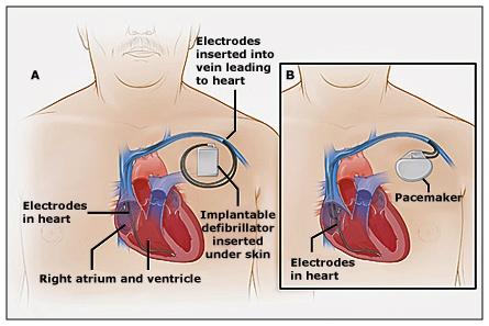 Pacemaker and an ICD: o Insertable Cardiac Monitor An insertable cardiac monitor is a small implantable device that continuously monitors heart rhythms and records them automatically or by using a