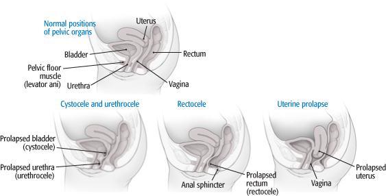 Cystoceles-bladder Urethrocele-urethra Cystourethrocele-combination of above Apical or uterine prolapse-uterus descends Enterocele-intestines Rectoceles-rectum Symptoms of celes