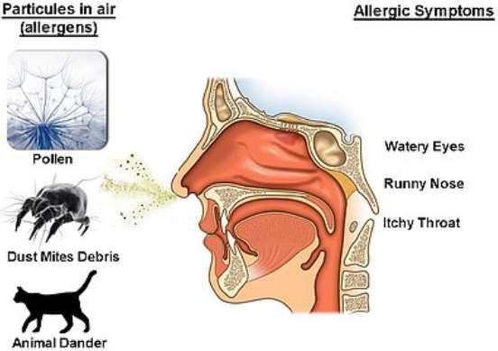 Upper airways cough syndrome Rhinitis/sinusitis