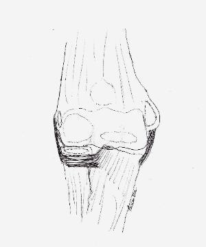 Medial Collateral ligament Arises from medial epicondyle