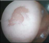 FACT ARTICULAR CARTILAGE LESIONS ARE FREQUENTLY ENCOUNTERED