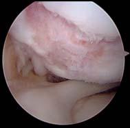 APPROACH TO ARTICULAR CARTILAGE
