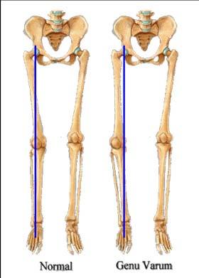 PATIENT ISSUES: THE KNEE LEG ALIGNMENT MENISCI STABILITY MOTION PREVIOUS SURGERY OVERALL KNEE HEALTH UNDERSTANDING INDICATIONS