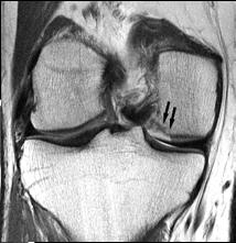 2010;92:994-1009 Improvement of knee function