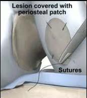 Cartilage Harvest 2 Cartilage Growth 3 Excision of Bad Cartilage 4 Patch covering 5 Injection of