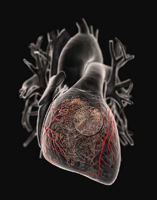 Therapeutic Modalities for Stimulation of Coronary Collateral Growth Mechanical