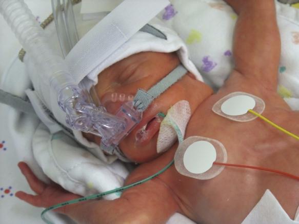 Potential to Transform Management of RDS Goal is to administer surfactant without invasive intubation and early in the management of RDS in premature infants Drug pumped through capillary Capillary