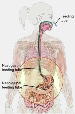 If you have an NG, there are two types of feeding, bolus feeding using a syringe, and pump feeding. Both types of feeding are described in the following sections.