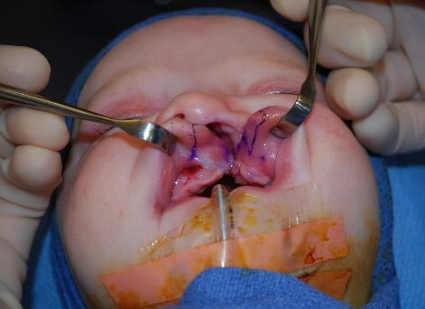 132 Unilateral Cleft Lip and Nasal Repair; JG Meara, et al Skin incisions Incisions are then made with a #15 blade scalpel along the medial skin markings first.