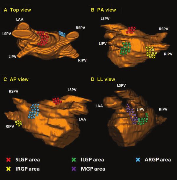 FP MODIFICATION ANALYZED BY LGE-MRI Figure 1. This figure shows the schematic image of the location of each GP area displayed on the LA image.