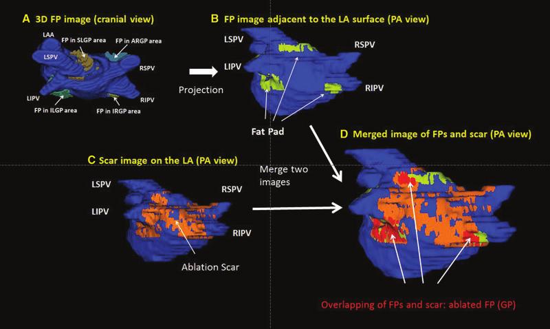 FP MODIFICATION ANALYZED BY LGE-MRI software. Areas which fell within that range of pixel intensities were highlighted using threshold tool (Fig. 2B).