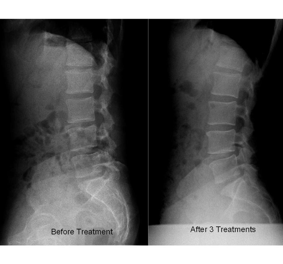 Patient before and After treatment A 37 year old patient presented with lower back. She experience pain for approx. month Job description- data capturer. Sits +/- 6 hours a day.