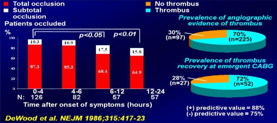 Thrombus in STEMI Over 70% of STEMI patients has angiographic evidence of thrombus