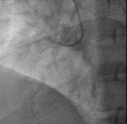 guiding Proximal embolization to
