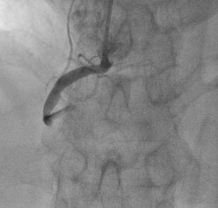 Case 6 Final angiography after