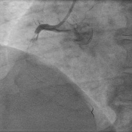 proximal RCA After