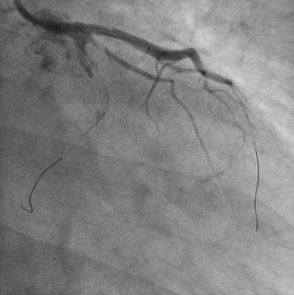 wired and thrombus seen after