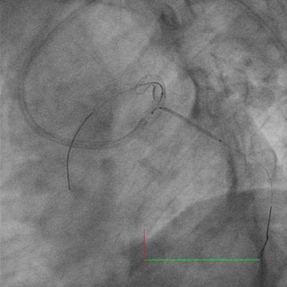 stenting to LAD