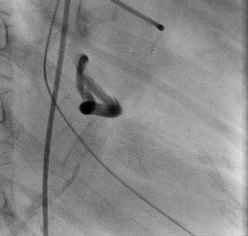 Case 15 Final Angiography After
