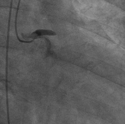 CABG as option for STEMI Presented with chest pain