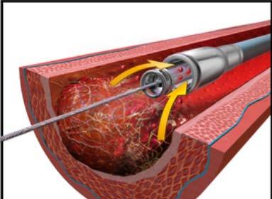 Thrombectomy For patients undergoing primary PCI, we suggest not performing routine manual thrombectomy (thrombus aspiration; aspiration thrombectomy).