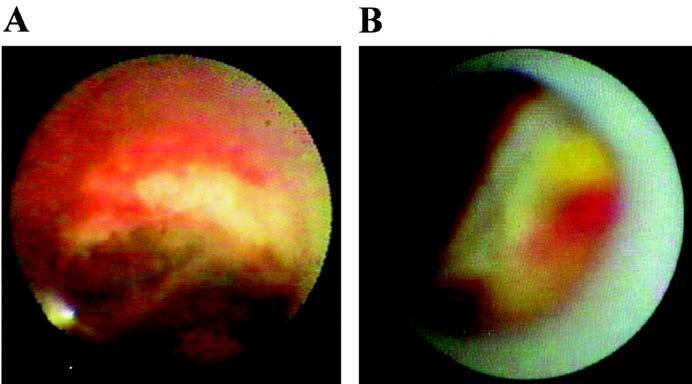 Type of leison No-reflow was most common in patients with a ruptured plaque treated without distal protection.