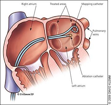Catheter Ablation h"p://www.