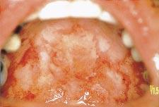Journal of the American Academy of Dermatology Volume 40, Number 5, Part 1 Robinson et al 653 The cutaneous lesions of paraneoplastic pemphigus are quite variable, consisting of a mixture of