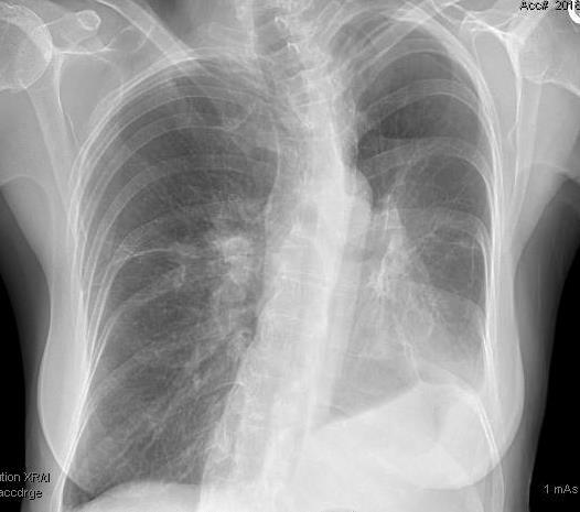 Lung Cancer Case Continued The patient