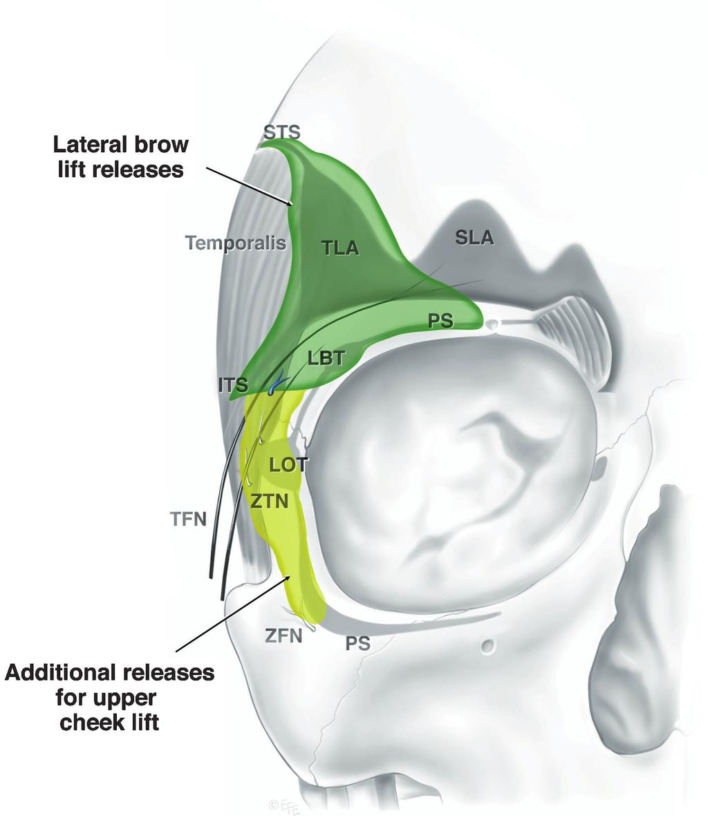 1488 PLASTIC AND RECONSTRUCTIVE SURGERY, April 2000 FIG. 14. Periorbital and temporal ligamentous attachments indicating the required amount of surgical ligamentous release: anterior view.