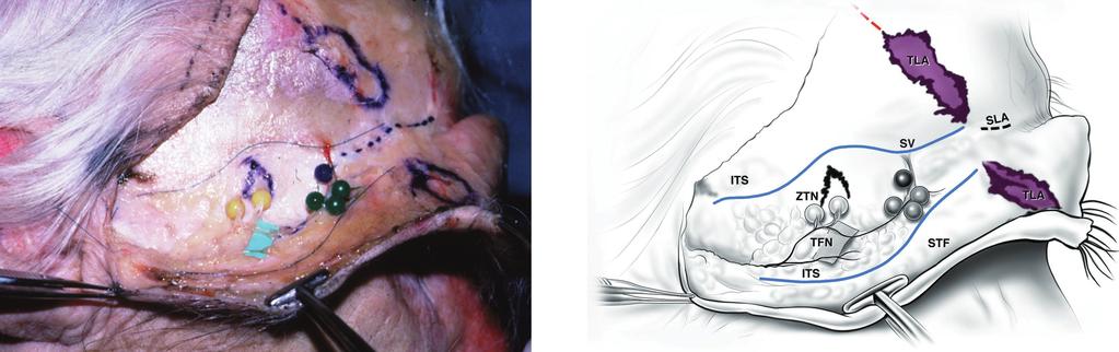 The scissors are releasing the temporal ligamentous adhesion (TLA) at the anterior end of the superior temporal septum (STS), which separates the frontal periosteum (FP) medially from the deep