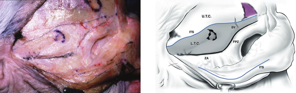 Vol. 105, No. 4 / SURGICAL ANATOMY OF LIGAMENTOUS ATTACHMENTS 1481 FIG. 6. Further elevation of the superficial temporal fascia. The three boundaries of the lower temporal compartment (L.T.C., shaded area) are seen, i.