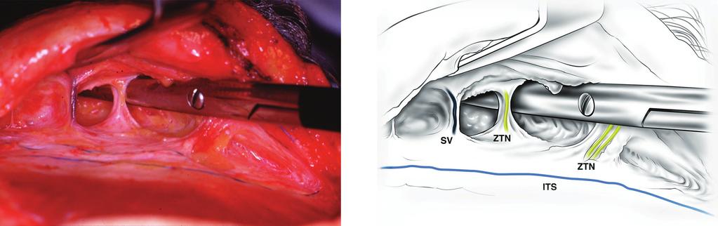 Same orientation as in Figure 7 after completion of the release of the inferior temporal septum (ITS) and release of the temporal ligamentous adhesion (TLA, triangular adhesion outlined with ink).
