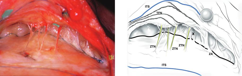 Vol. 105, No. 4 / SURGICAL ANATOMY OF LIGAMENTOUS ATTACHMENTS 1483 FIG. 10. Dissection of the underside of the roof of the lower temporal compartment.
