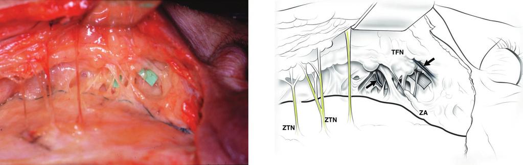 These branches pass perpendicular to the branches of the zygomaticotemporal nerve (ZTN) as they perforate the superficial temporal fascia. SV, sentinel vein; ITS, inferior temporal septum. FIG. 11.