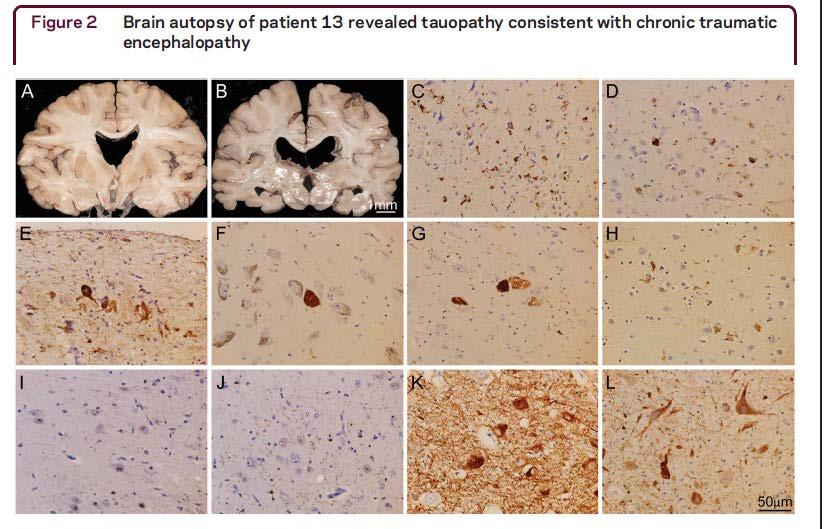 CTE at Autopsy in Aβ-PET Negative AD 79 year-old retired NFL