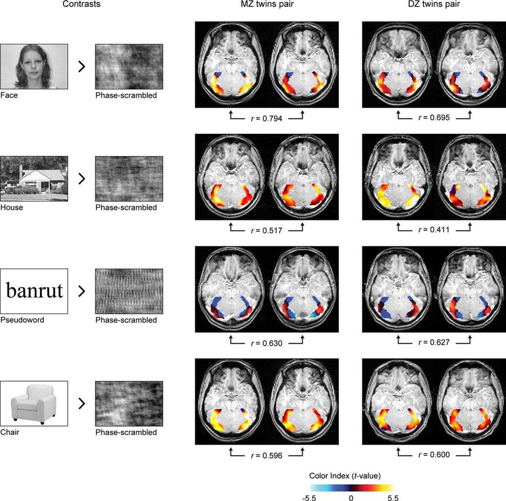 Polk et al. Nature versus Nurture in Ventral Visual Cortex J. Neurosci., December 19, 2007 27(51):13921 13925 13923 Figure1.