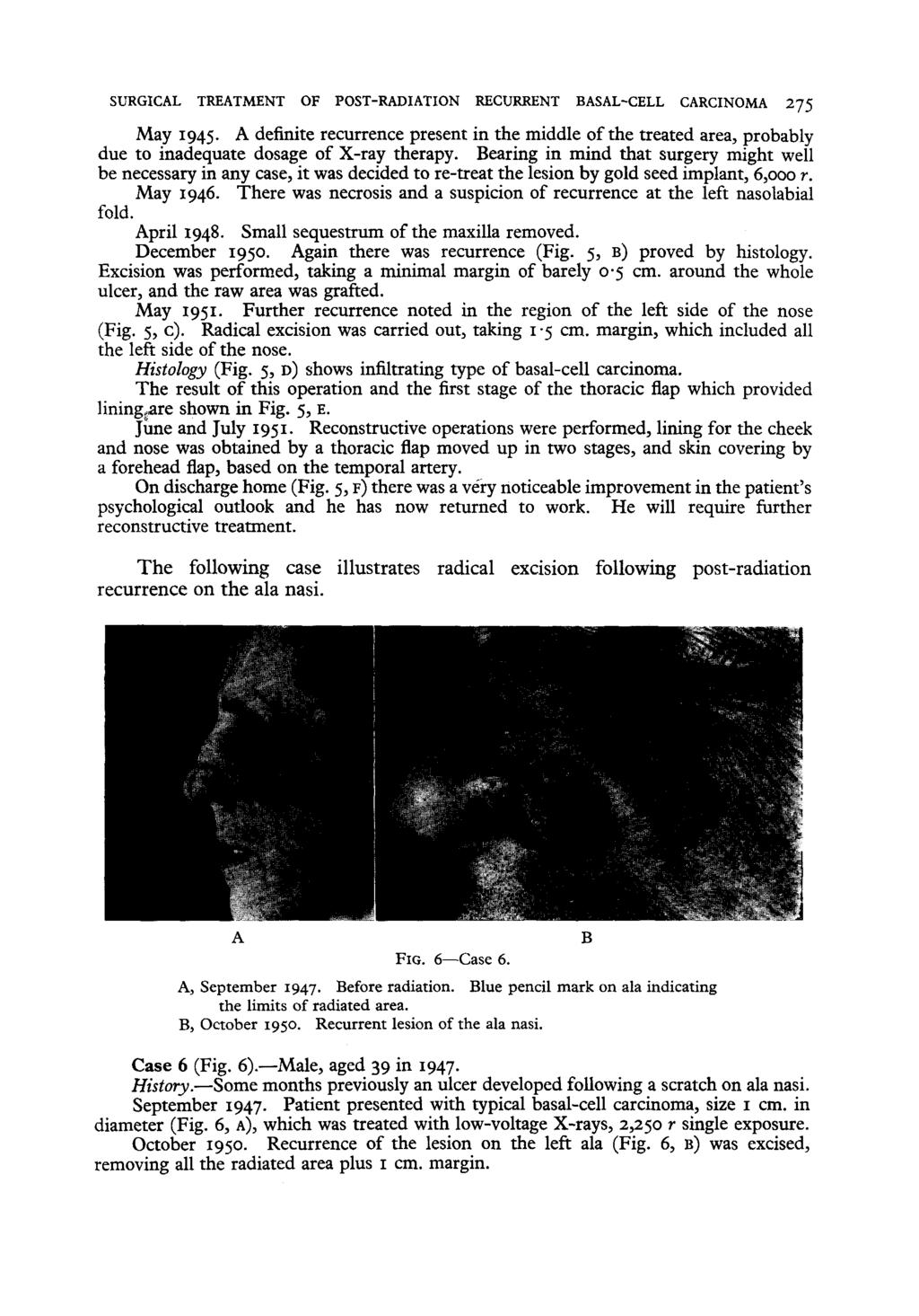 SURGICAL TREATMENT OF POST-RADIATION RECURRENT BASAL-CELL CARCINOMA 275 May 1945- A definite recurrence present in the middle of the treated area, probably due to inadequate dosage of X-ray therapy.