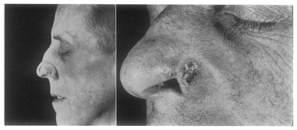 There was necrosis and a suspicion of recurrence at the left nasolabial fold. April 1948. Small sequestrum of the maxilla removed. December 195o. Again there was recurrence (Fig.