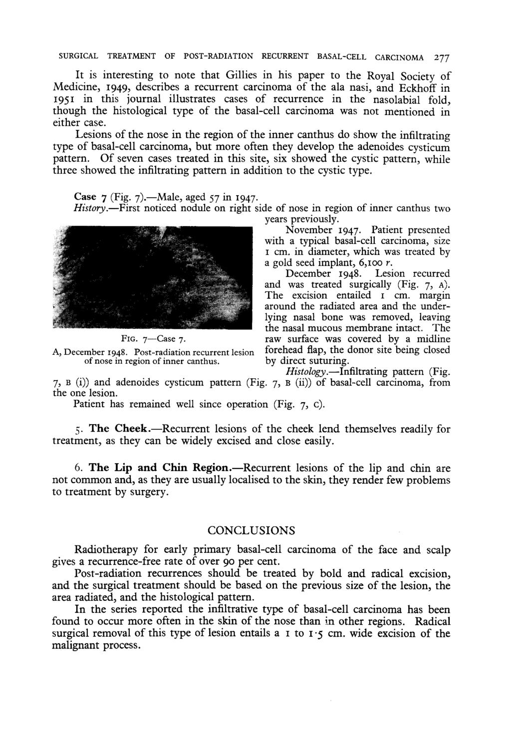 SURGICAL TREATMENT OF POST-RADIATION RECURRENT BASAL-CELL CARCINOMA 277 It is interesting to note that Gillies in his paper to the Royal Society of Medicine, 1949, describes a recurrent carcinoma of