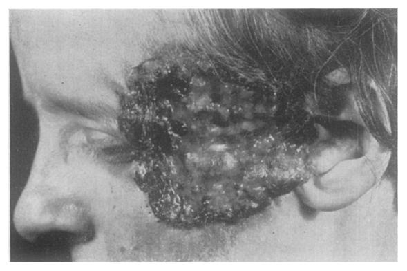 Lesion again recurred in the same area and was treated by diathermy and excision. A FIG. 2--Case 2. A, December 1942. Before radiotherapy.