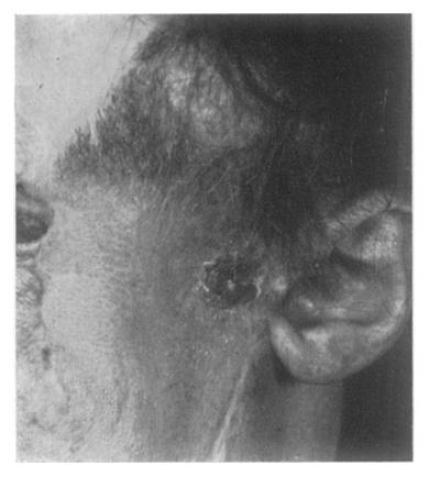 sacrifice the temporo-mandibular joint at operation. Secondly, the histological pattern E F FIG. 2--Case 2. E, November 1947. Recurrence in flap. F, November 1947.